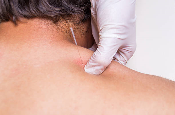 Dry needling fisioterapia​ em Barueri