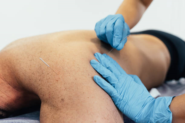 Dry needling valor da sessão​