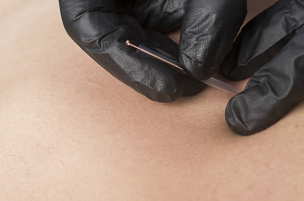 Dry needling valor da sessão​ em Alphaville